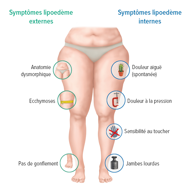 Graphique Symptômes lipœdème Graphique Symptômes lipœdème