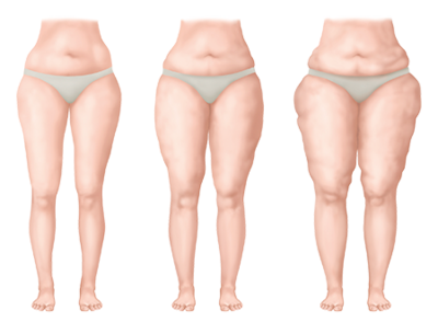 The stages of lipoedema Diagram showing the stages of lipoedema