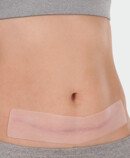 Juzo ScarPad, application on the abdomen Juzo ScarPad, application on the abdomen