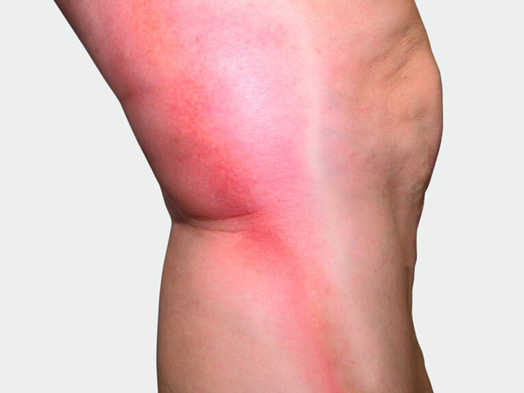Beininnenseite, an der man eine rote Verfärbung sieht Beininnenseite, an der man eine rote Verfärbung sieht