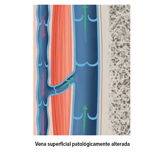 Vena superficial patológicamente alterada Vena superficial patológicamente alterada