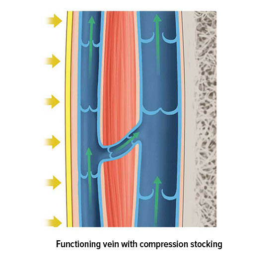 Functioning vein with compression stocking Functioning vein with compression stocking