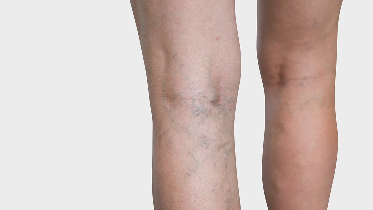 Beininnenseite, an der man Besenreiser sieht Beininnenseite, an der man Besenreiser sieht