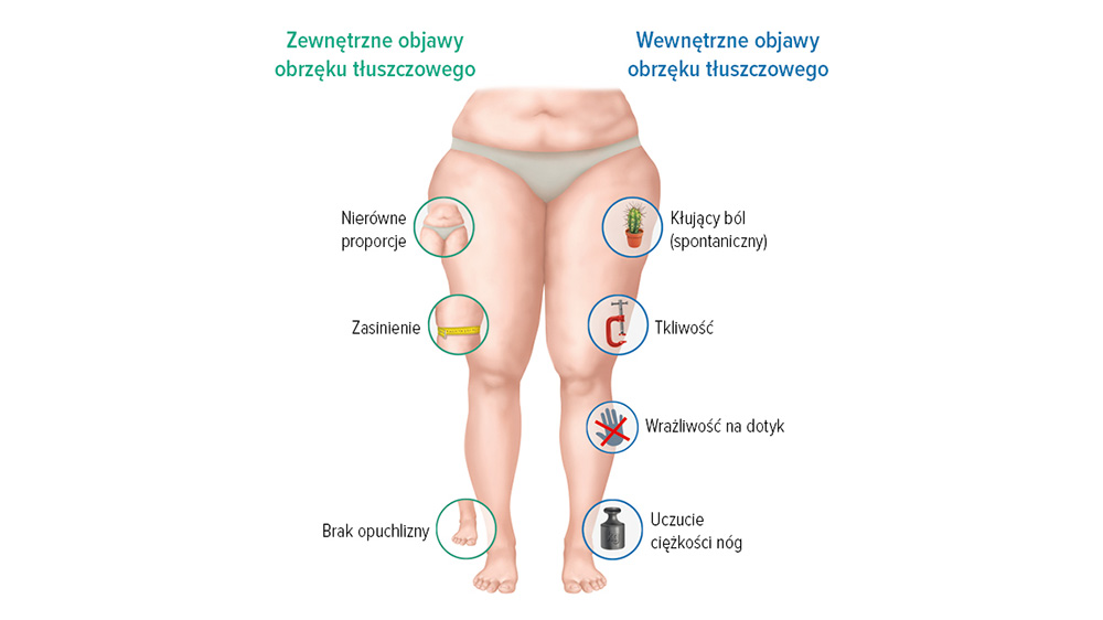Objawy obrzęku limfatycznego Objawy obrzęku limfatycznego